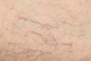 Étoiles vasculaires