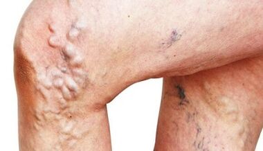 Les principales manifestations des varices sur les jambes