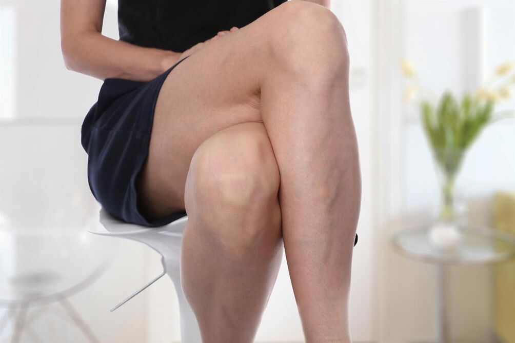 Varices chez une femme