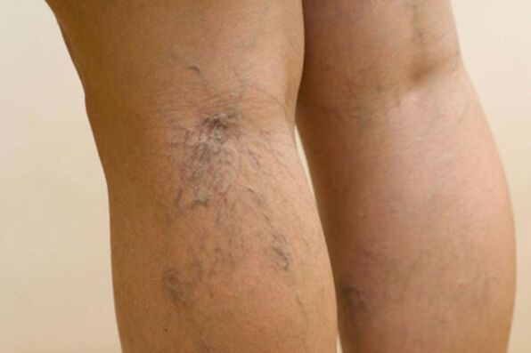varices dans les jambes des femmes
