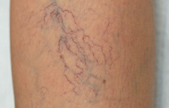 varices sur les jambes chez les femmes