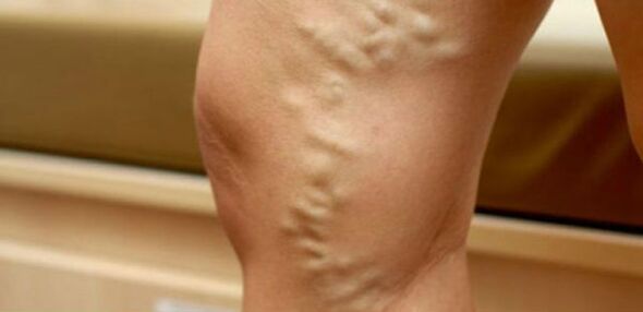 varices sur les jambes des femmes