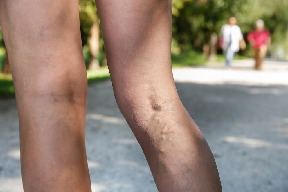 varices sur les jambes