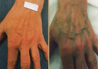 causes des varices sur les mains
