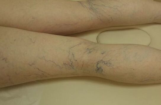 Varicose étoiles sur les jambes