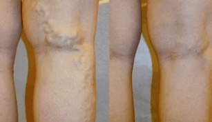 signes et symptômes de varices sur les jambes chez les hommes