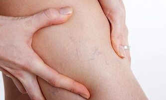 raisons du développement de varices dans les jambes