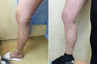 traitement au laser des varices avant et après les photos