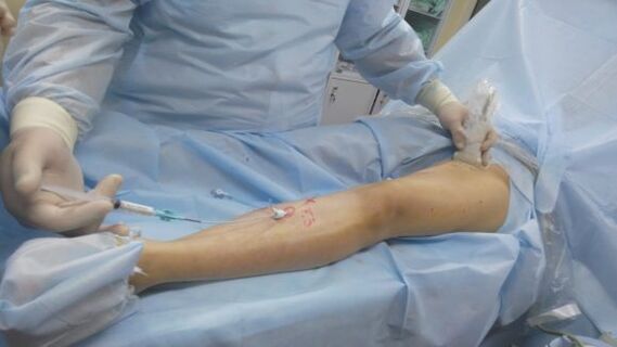 chirurgie des varices des jambes