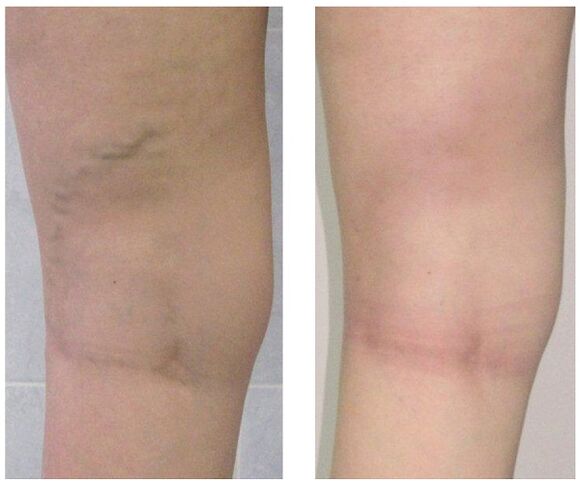 veine de la jambe avant et après le traitement des varices