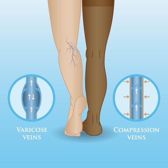 Effets des vêtements de compression sur les varices des jambes