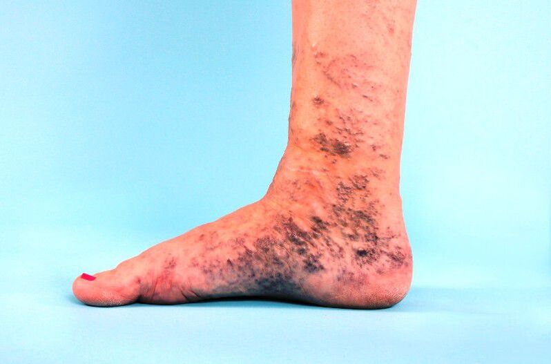 varices négligées sur la jambe