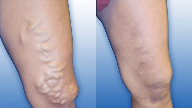 Jambes avant et après le traitement des varices sévères