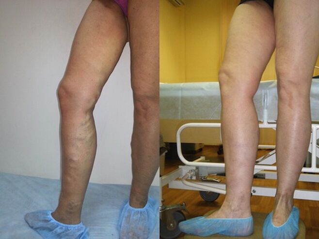 Jambes avant et après traitement au laser des varices