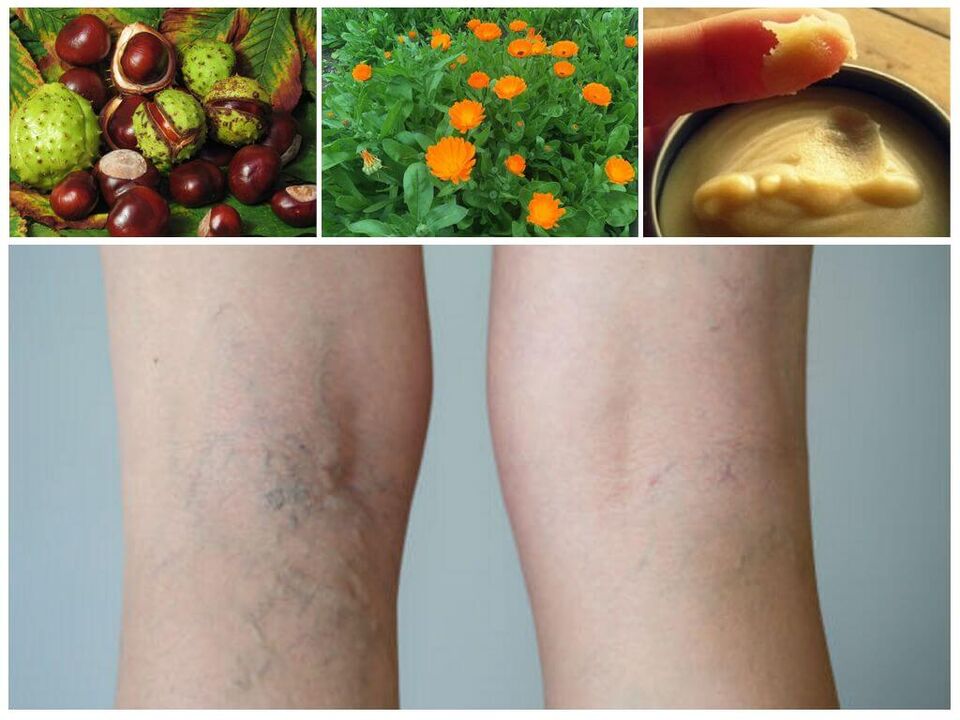 varices sur les jambes et remèdes populaires pour sa prévention