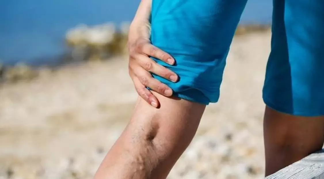 Les veines bleues saillantes sur les jambes sont un signe de varices